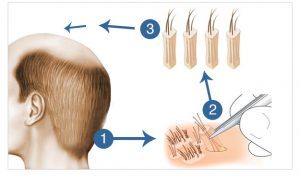 fue hair transplant abroad