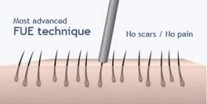 FUE technique for lasting hair transplant