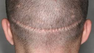 FUE vs strip method for hair transplant