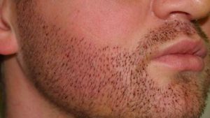 How much does beard hair transplant cost?