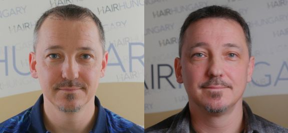 Before and after hair transplant images Budapest, Hungary