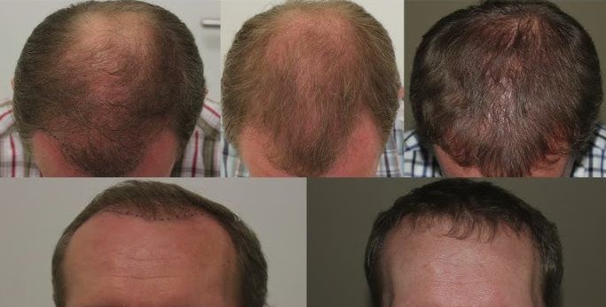 Stages and results before and after hair transplants in Budapest, Hungary