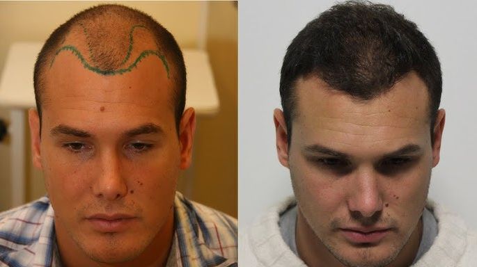 Hairline design and hair transplant for receding hairline in Budapest, Hungary