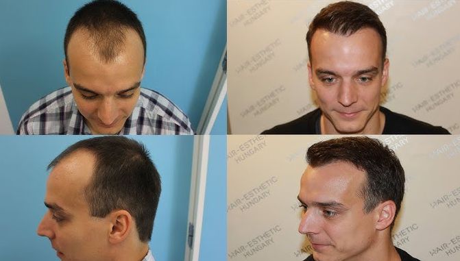 Months after hair transplant - results and before and after images of hair transplant in Budapest Hair Clinic